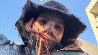 Potret Shaloom Razade Setelah Oplas, Wajah Masih Bengkak & Hidung Diperban