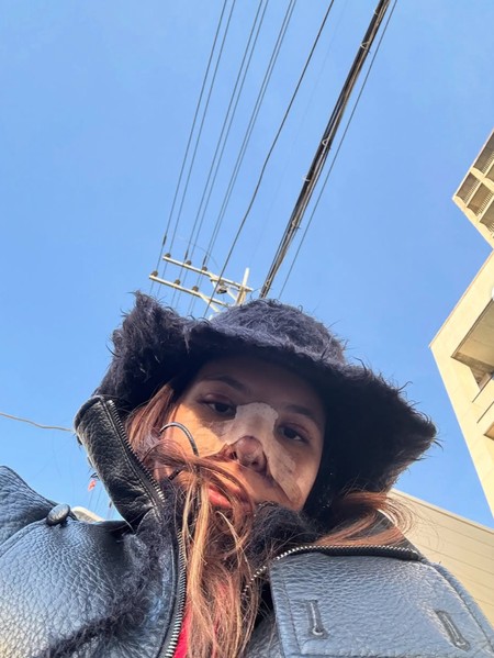 Potret Shaloom Razade Setelah Oplas, Wajah Masih Bengkak & Hidung Diperban