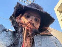 Potret Shaloom Razade Setelah Oplas, Wajah Masih Bengkak & Hidung Diperban