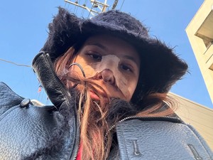 Potret Shaloom Razade Setelah Oplas, Wajah Masih Bengkak & Hidung Diperban