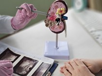 Video: Pria Ini Alami Kerusakan Ginjal Gegara Kebanyakan Minum Vitamin D