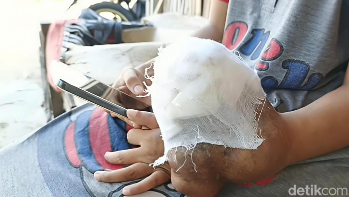 Mega Fitria Dewi (24), penderita kanker tulang asal Desa Dermayu, Kecamatan Sindang, Kabupaten Indramayu.