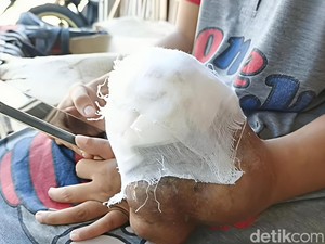 Cerita Benjolan dan Mega yang Menahan Nyeri Tak Berkesudahan