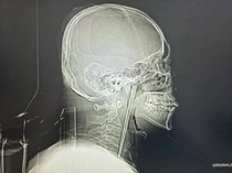 Ngeri! Sumpit Logam 12 Cm Tersangkut di Tenggorokan Pria Selama 8 Tahun