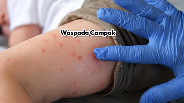 Waspada Campak