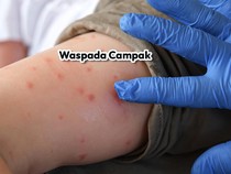 Bandung Catat 248 Kasus Suspek Campak Hingga Maret 2024