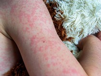 Video: Kemenkes Klaim Kasus Campak Turun 93%, Pengawasan Tetap Ketat