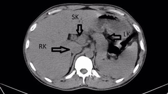Penampakan Ginjal Ketiga pada Pria India, Bentuknya Mirip Tapal Kuda