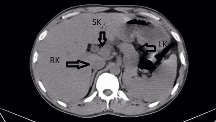 Penampakan Ginjal Ketiga pada Pria India, Bentuknya Mirip Tapal Kuda
