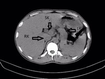 Ginjal Ketiga Pria di India Bentuknya Mirip Tapal Kuda
