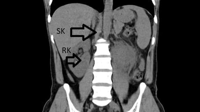 Pria 31 Tahun Niat Berobat gegara ISK Parah, Dokter Malah Temukan Ginjal Ketiga