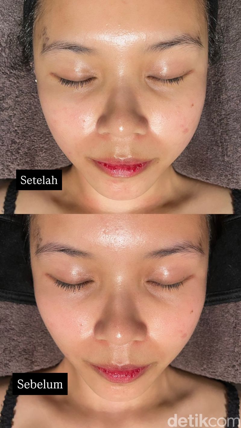 Pijat Buccal Facial Contour