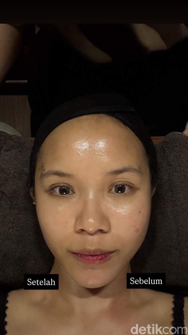 Pijat Buccal Facial Contour
