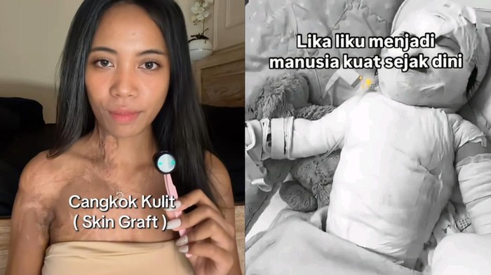 Wanita Bali menjalani transplantasi kulit karena luka bakar.