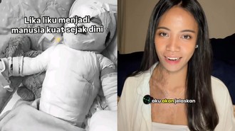 Viral Cerita Wanita Bali Jalani Transplantasi Kulit usai Alami Luka Bakar 85 Persen