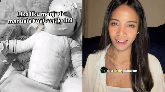 Wanita Bali menjalani transplantasi kulit karena luka bakar.