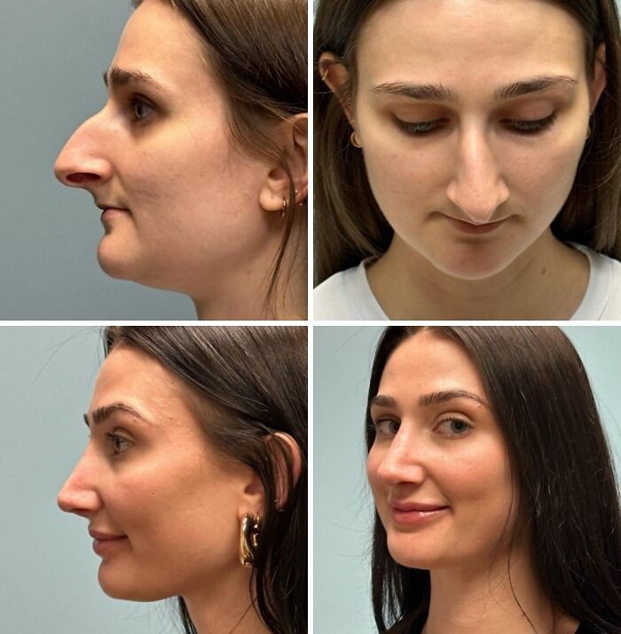 Hasil operasi plastik yang proporsional Contoh operasi plastik dengan hasil alami