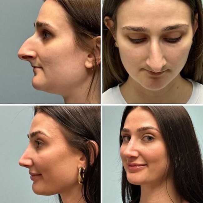 10 Before-After Operasi Plastik dengan Hasil Mengagumkan