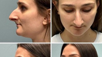 10 Before-After Operasi Plastik dengan Hasil Mengagumkan