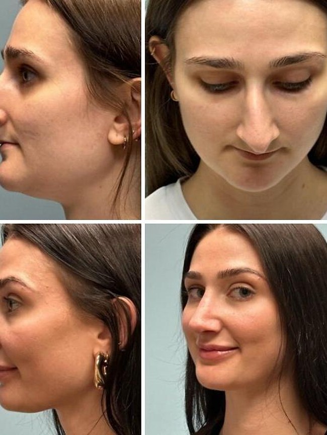 10 Before-After Operasi Plastik dengan Hasil Mengagumkan