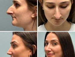 10 Before-After Operasi Plastik dengan Hasil Mengagumkan