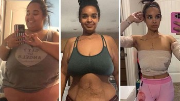 Dari 162 kg menjadi 52 kg, transformasi luar biasa. Membuang sisa kulit memang harus pakai operasi. Foto: Automatic-Chest-4721 via Bored Panda