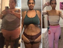 10 Before-After Operasi Plastik dengan Hasil Mengagumkan