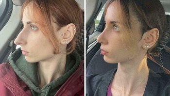 Satu bulan setelah operasi hidung. Cantik. Foto: trash_cant1 via Bored Panda