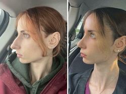 10 Before-After Operasi Plastik dengan Hasil Mengagumkan