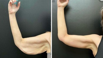 Brachioplasty, untuk membuang sisa kulit setelah turun puluhan kilo. Foto: Dinosaurateme via Bored Panda