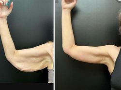 10 Before-After Operasi Plastik dengan Hasil Mengagumkan