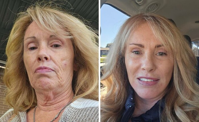 Di era modern, operasi plastik sudah bukan lagi hal yang tabu. Berikut ini beberapa hasil operasi plastik yang mengagumkan dan menambah rasa percaya diri.