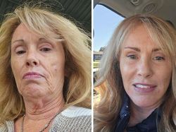 10 Before-After Operasi Plastik dengan Hasil Mengagumkan