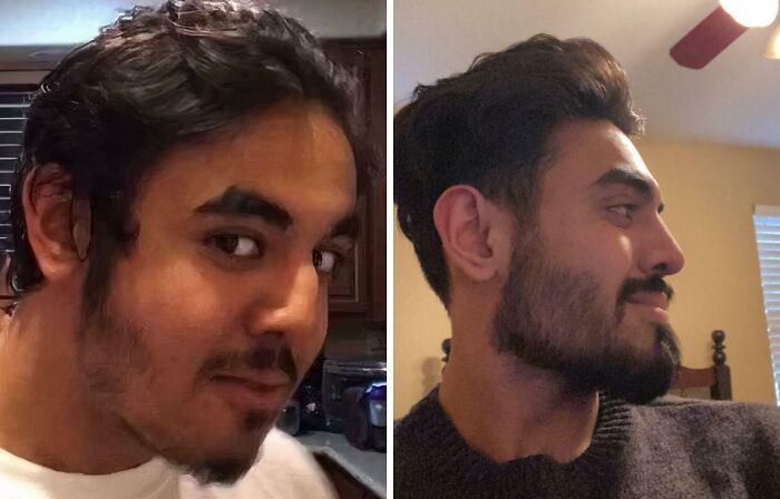 Hasil septorhinoplasty setelah dua tahun Transformasi hidung pasca septorhinoplasty