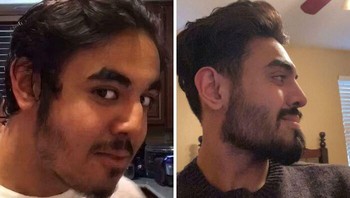 2 Tahun pasca operasi septorhinoplasty. Ini adalah operasi kosmetik yang bertujuan untuk mengubah bentuk hidung, tetapi juga bisa memiliki tujuan medis untuk memperbaiki fungsi pernapasan. Foto: Fuzuza via Bored Panda