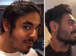 10 Before-After Operasi Plastik dengan Hasil Mengagumkan