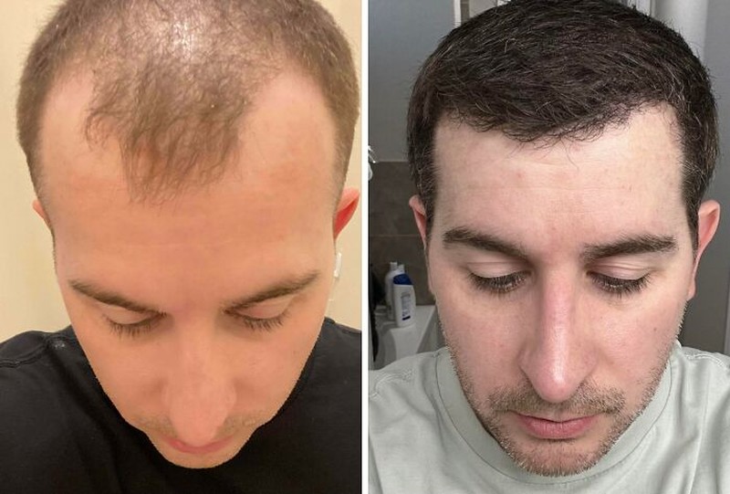 Di era modern, operasi plastik sudah bukan lagi hal yang tabu. Berikut ini beberapa hasil operasi plastik yang mengagumkan dan menambah rasa percaya diri.