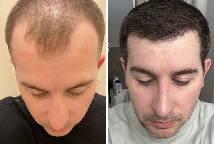 Hasil transplantasi rambut setelah lima bulan Perubahan garis rambut pasca transplantasi rambut