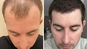 5 bulan pasca transplantasi rambut. Foto: FrenchAndRaven via Bored Panda