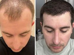 10 Before-After Operasi Plastik dengan Hasil Mengagumkan