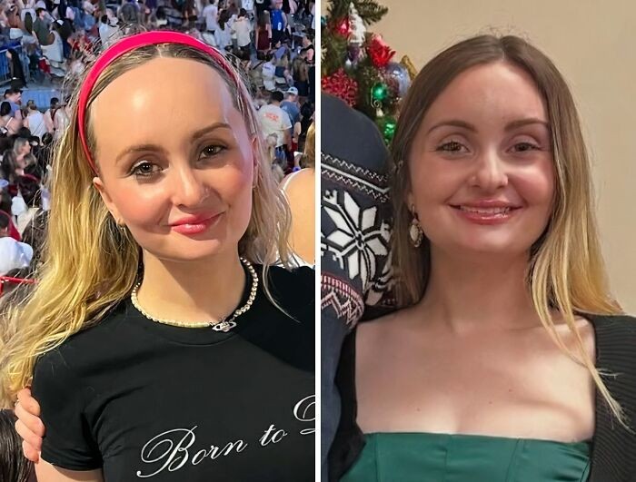 Hasil operasi pengurangan ukuran dahi Transformasi dahi pasca operasi