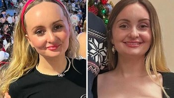 Operasi pengurangan ukuran kening. Foto: freshavocado21 via Bored Panda