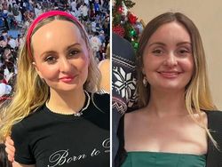 10 Before-After Operasi Plastik dengan Hasil Mengagumkan