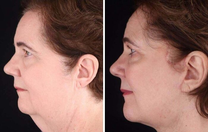 Hasil deep plane face and neck lift Transformasi wajah dan leher pasca facelift