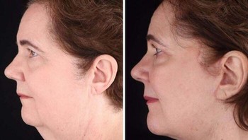 Deep plane face and neck lift. Foto: pointsettia1 via Bored Panda