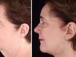 10 Before-After Operasi Plastik dengan Hasil Mengagumkan