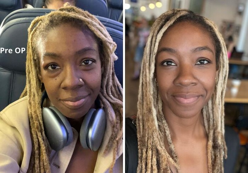 10 Before-After Operasi Plastik dengan Hasil Mengagumkan