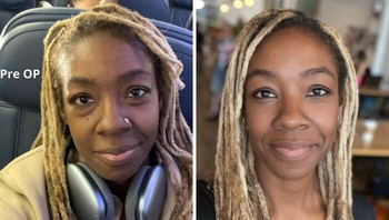 Kantong mata makin terlihat karena bertambah usia (46 tahun) dan tubuhnya kurusan. Operasi seharga USD 4.500 atau sekitar Rp 76 juta dan hasilnya seperti ini. Foto: International_Ad8501 via Bored Panda