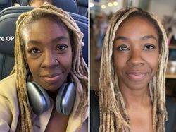 10 Before-After Operasi Plastik dengan Hasil Mengagumkan