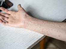 Waspada! Campak di Sumsel Tembus 1.576 Kasus dengan 446 Positif